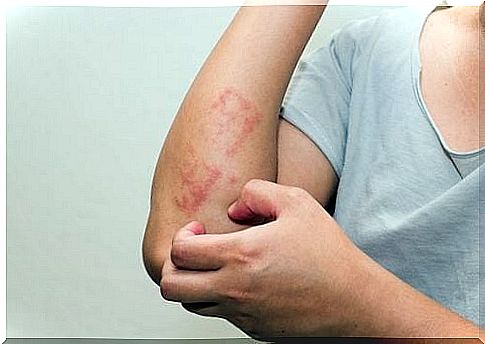 Remedies for psoriasis - remedies against psoriasis