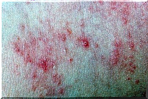 Chronic hives in children