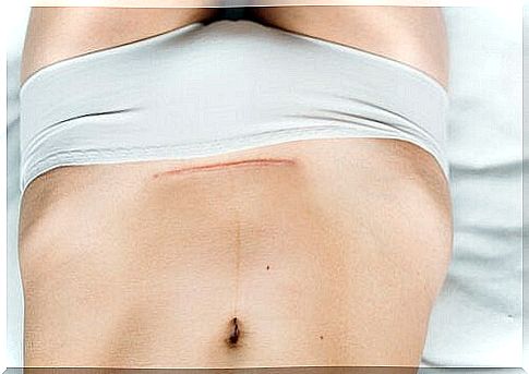 Scar care after a caesarean section