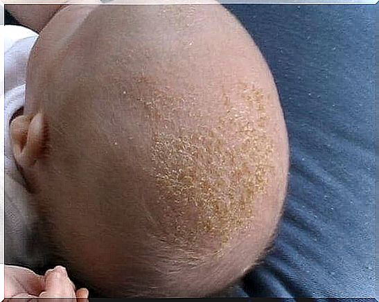 Seborrheic eczema in babies >> skin disease