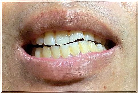 Stains on teeth