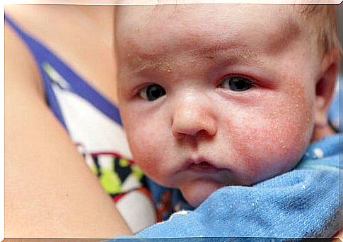 Eczema can cause flaky skin in newborns